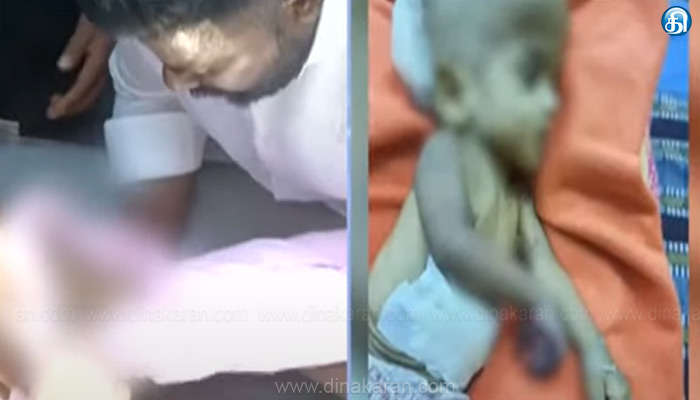 ஒன்றரை வயது குழந்தையின் கை அகற்றப்பட்ட விவகாரத்தில், மருத்துவக்குழுவின் விசாரணை அறிக்கை வெளியீடு